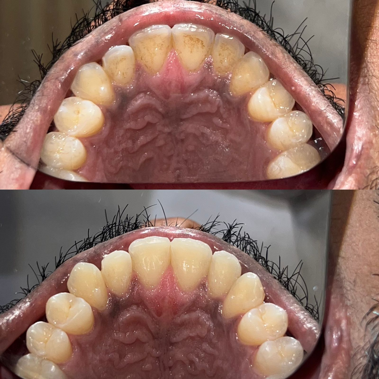 Before Teeth Cleaning